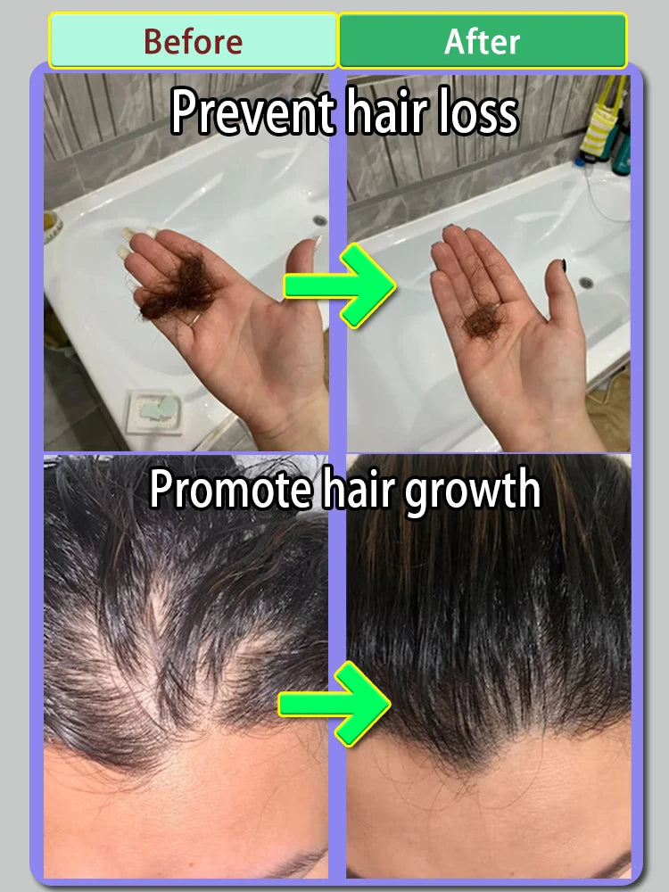 Best-selling global anti-hair loss men's and women's hair growth