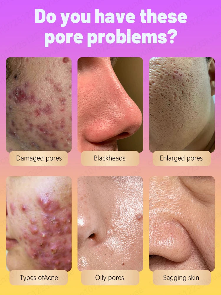 pores remover