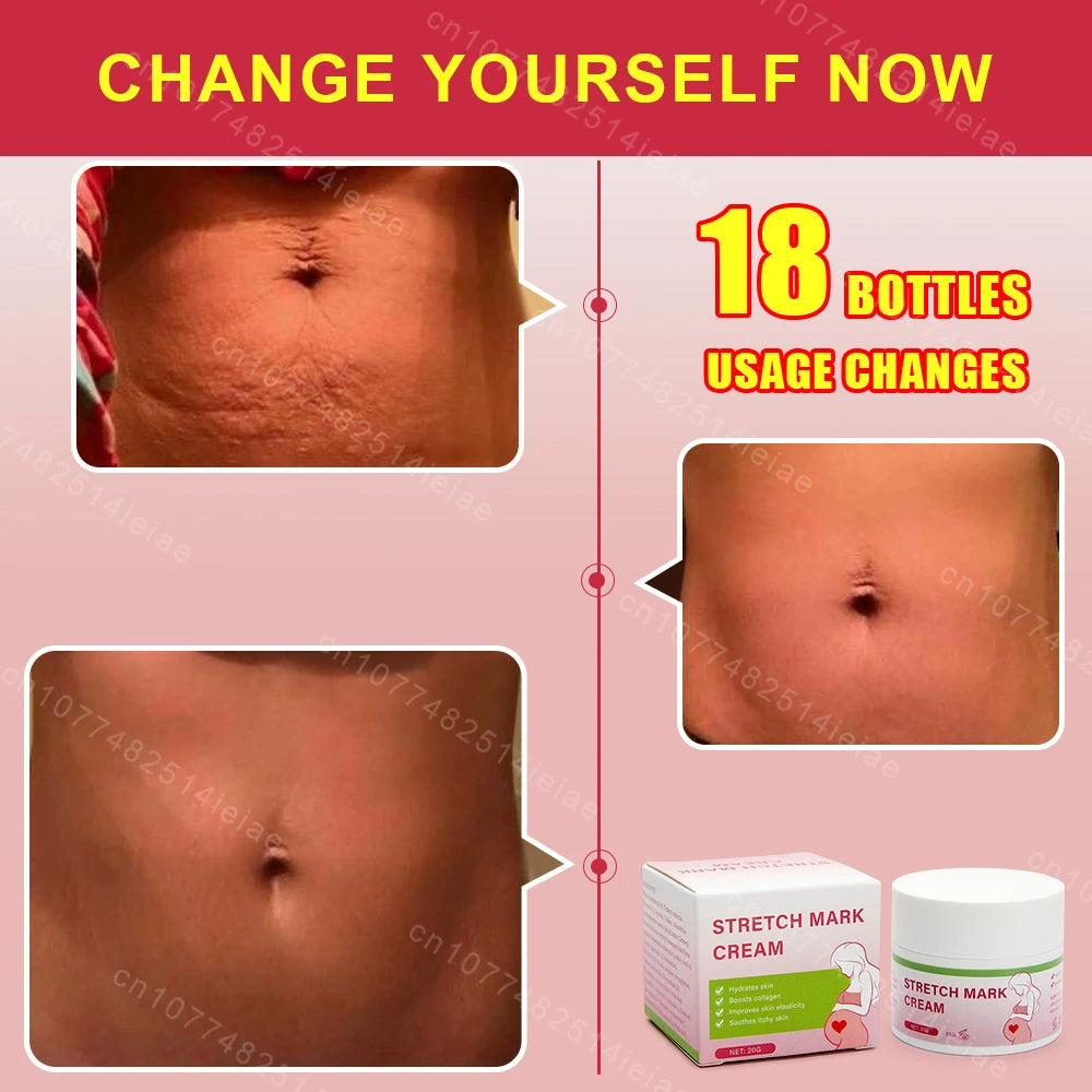 Pregnancy Mark Removal Cream Permanent Repairs Damaged Skin