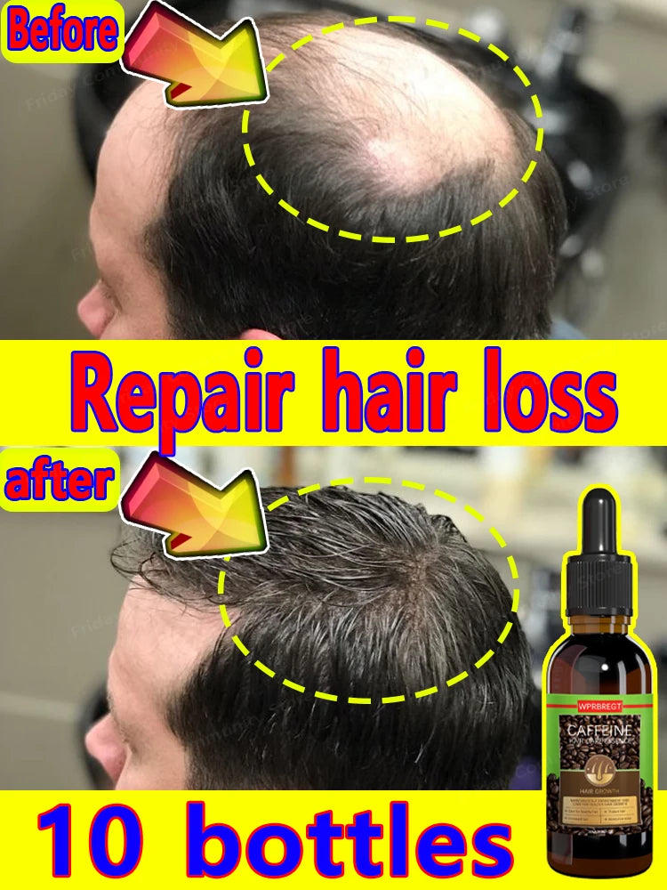 Best-selling global anti-hair loss men's and women's hair growth