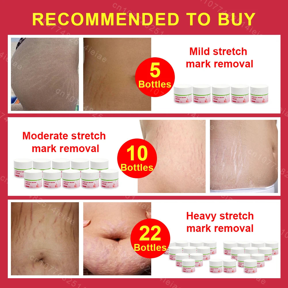 Pregnancy Mark Removal Cream Permanent Repairs Damaged Skin