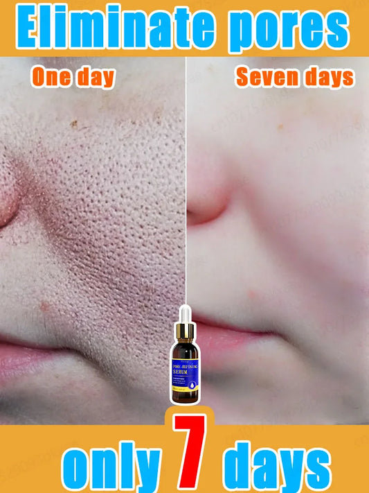 pores remover