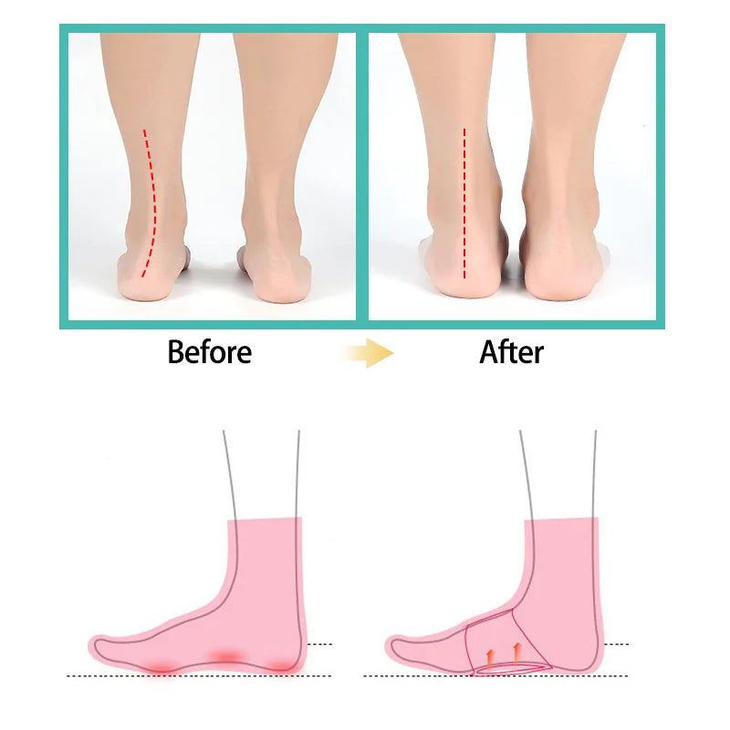 2 Pcs Foot Arch Support Flat Foot Insoles